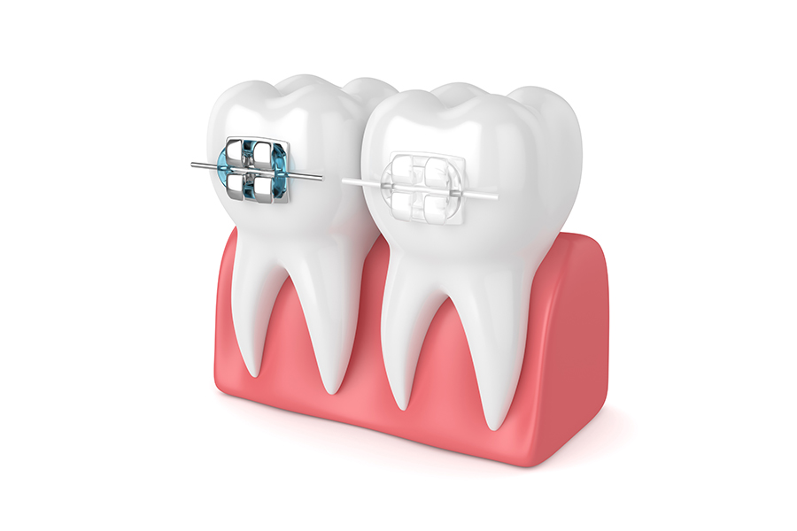 部分矯正について