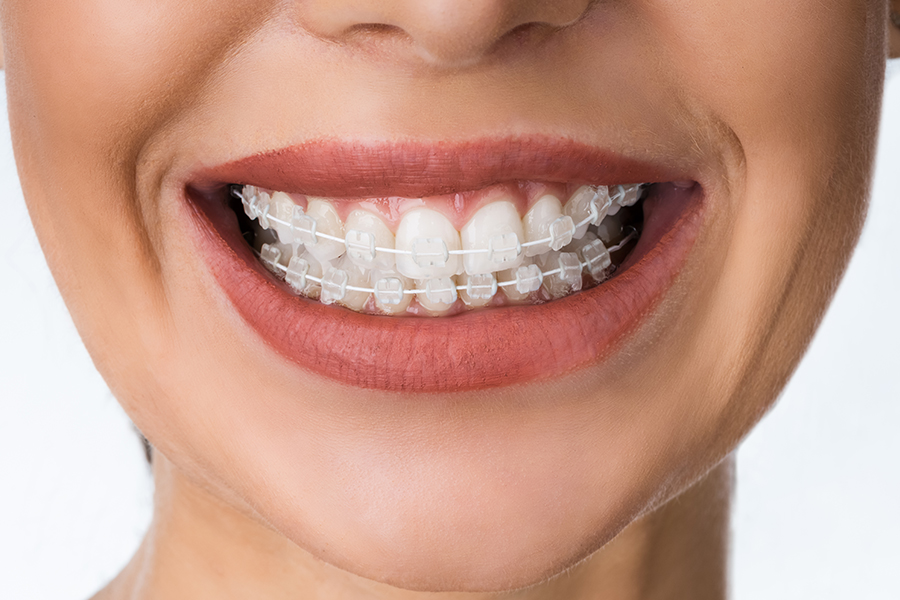 成人矯正について