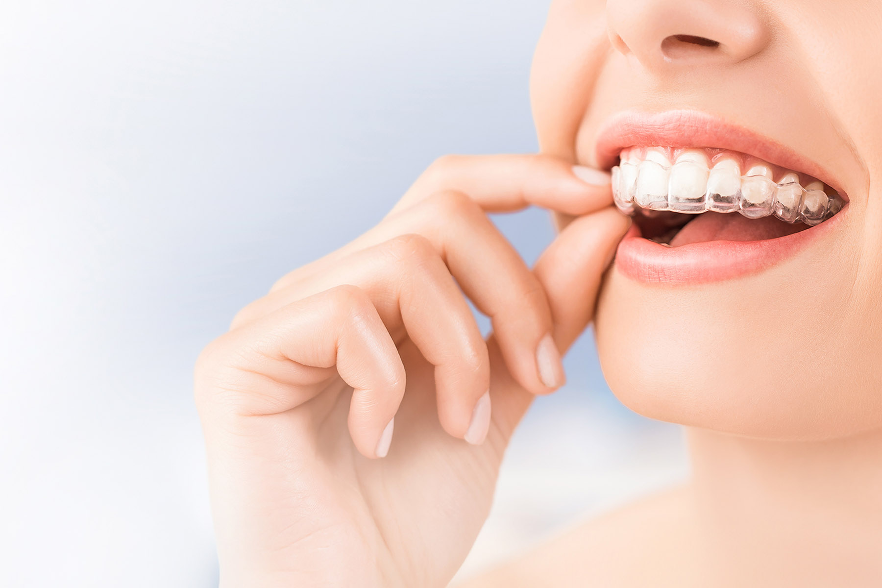 マウスピース矯正