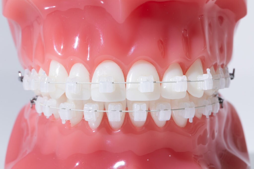 表側矯正(ワイヤー)